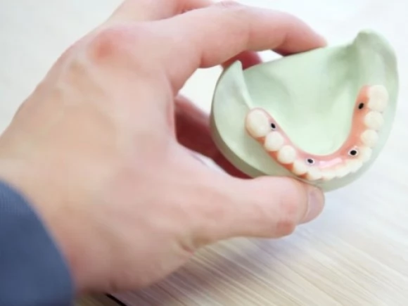 Ugradnja implantata zuba – prednosti i mane