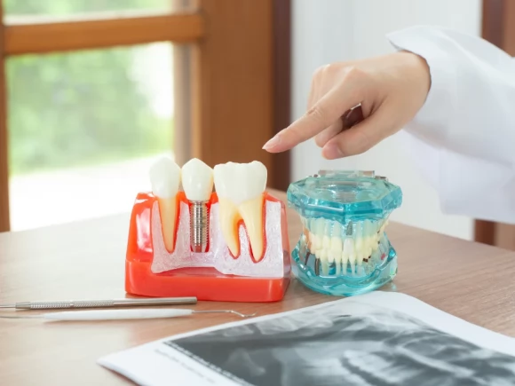 Zubni implanti su bolja opcija od proteza